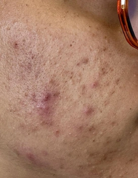 Close-up of a person's cheek showing inflammatory acne, red pustules, and pitted acne scars with uneven skin texture